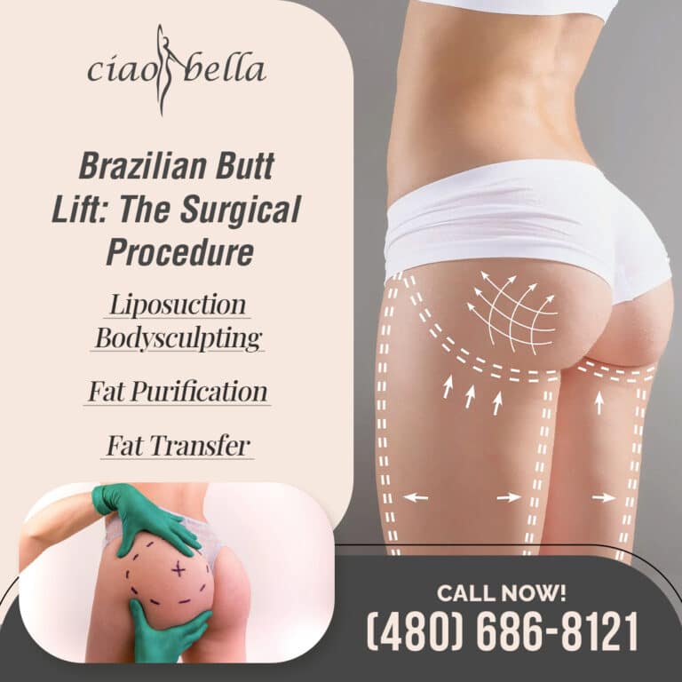 Brazilian butt lift