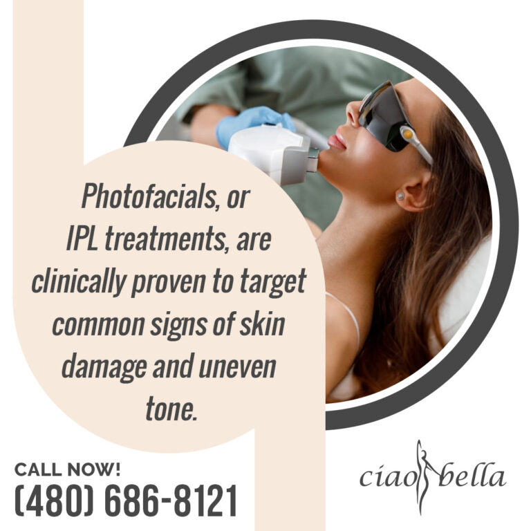 Photofacial (IPL) Treatment
